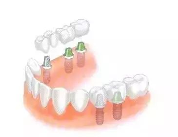 什么是“种植牙”？它有哪些好处？  